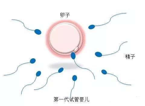 无精症